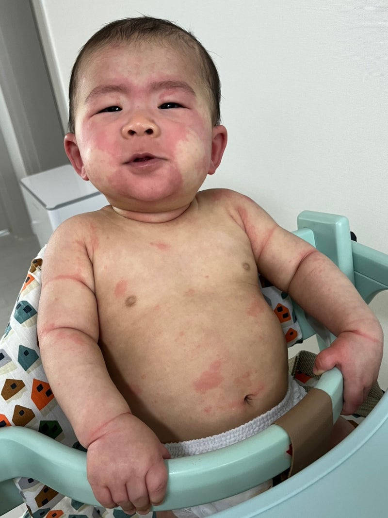 8개월 아기_계란 흰자 알러지 테스트 후 알레르기 반응 및 증상 : 피부발진, 두드러기, 열감 ....