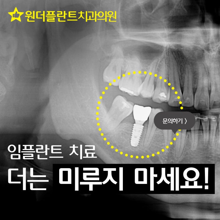  임플란트 선택이 중요한 이유 그리 맞춤형 지대주 추천