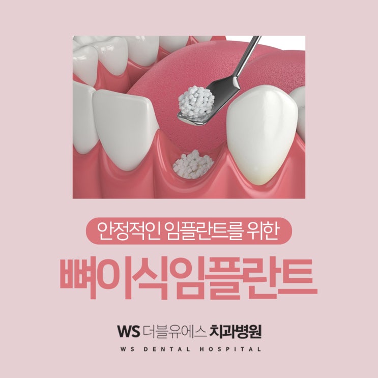  부산뼈이식임플란트 자연스럽게 채우자