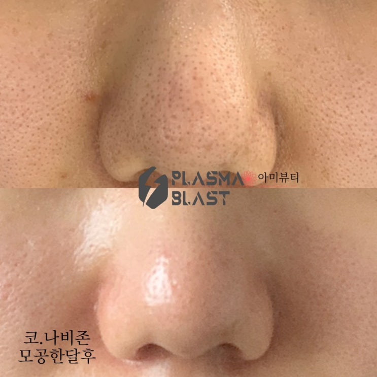  피부 고민의 시작, 모공과 블랙헤드!대구 아미뷰티에서 플라즈마로 한방에 해결! !