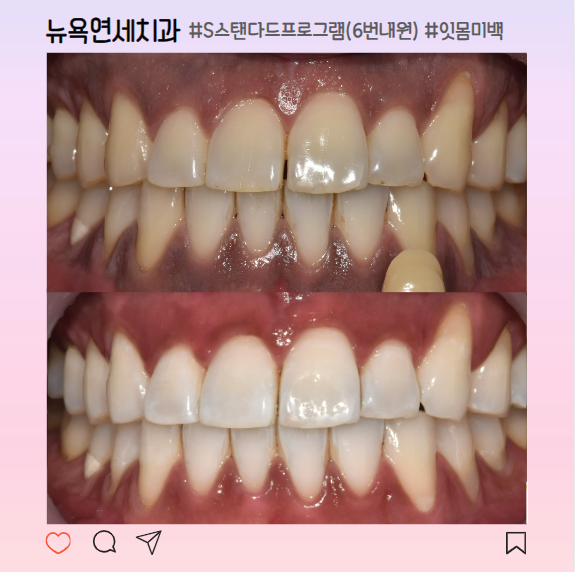 강남역 치과 치아미백 잘하는 곳 추천, 전후 비교