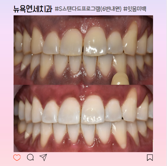  강남역 치과 치아미백 잘하는 곳 추천, 전후 비교