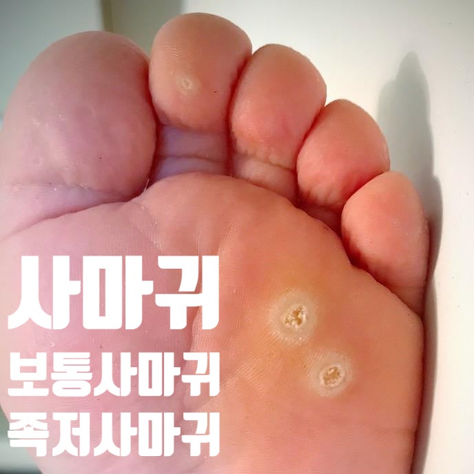  발바닥 사마귀 치료의 모든 것 (냉동치료/블레오마이신/면역치료/레이저/시메티딘/가다실)