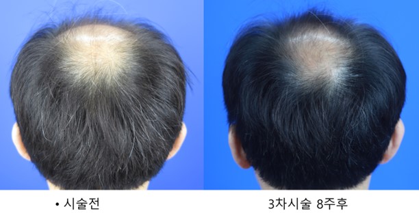  활성 혈소판을 이용한 탈모치료