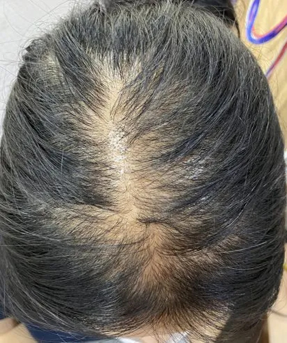  정수리 탈모, 활성 혈소판 치료를 권장하는 이유