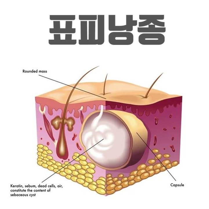  표피낭종 (Epidermal cyst)