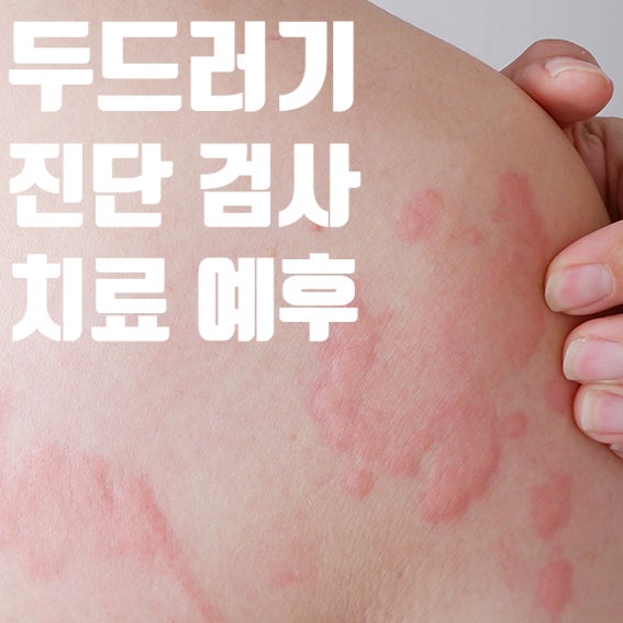  두드러기의 진단/검사/치료/예후