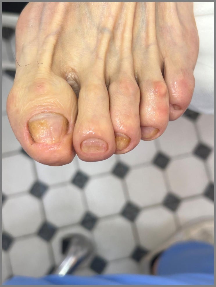  레푸스 부산덕천점 :: 부산발톱무좀 내성발톱 관리