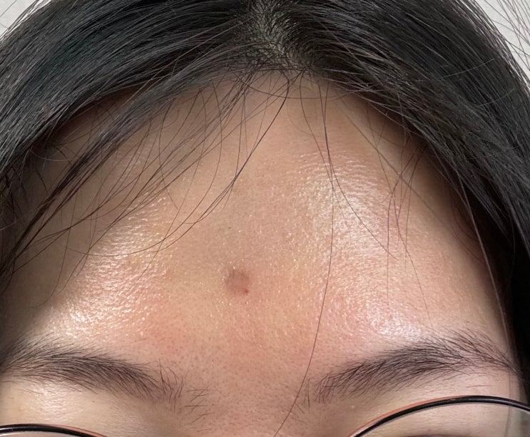 홍대 흉터치료 수두자국제거 3회차 후기 홍대 흉터치료 수두자국제거 3회차 후기