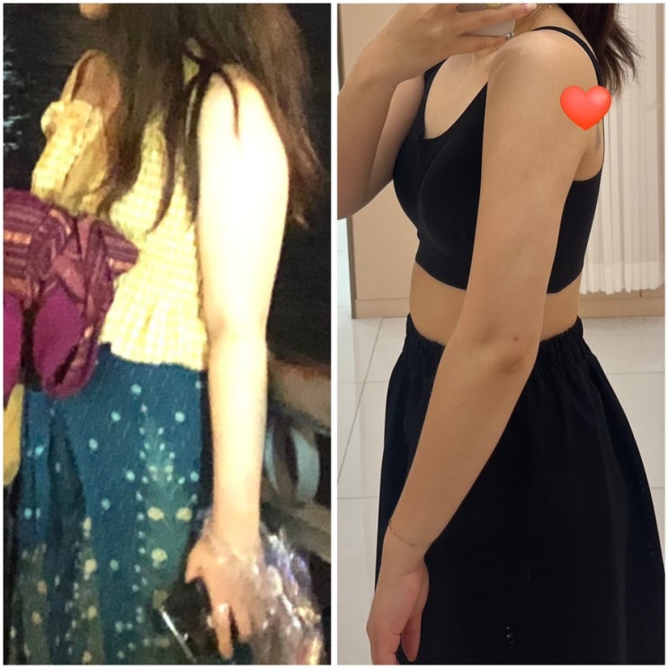  노원 팔무한람스 두달 후기 사이즈 3.6cm, 몸무게 3.5kg 감량 +부유방까지 없어짐,,