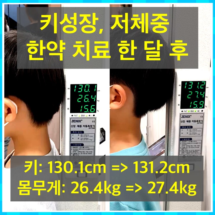  성장 프로그램 한 달만에 키 1.1cm 자란 환자분 후기