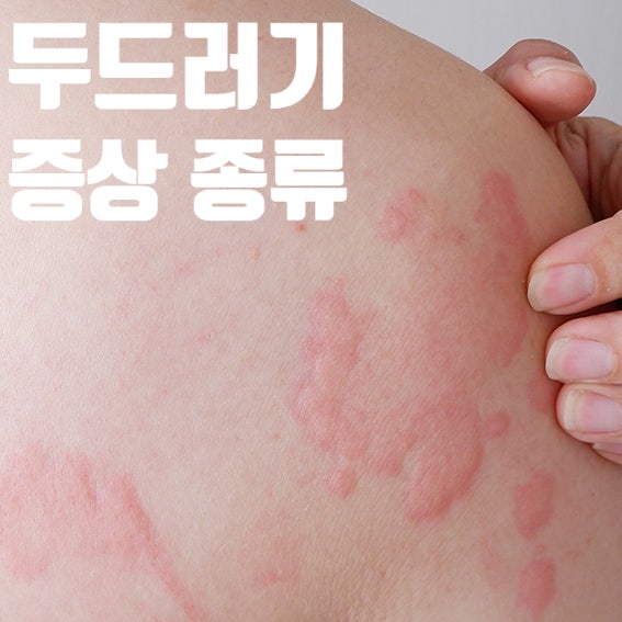 두드러기의 증상/정의와 종류