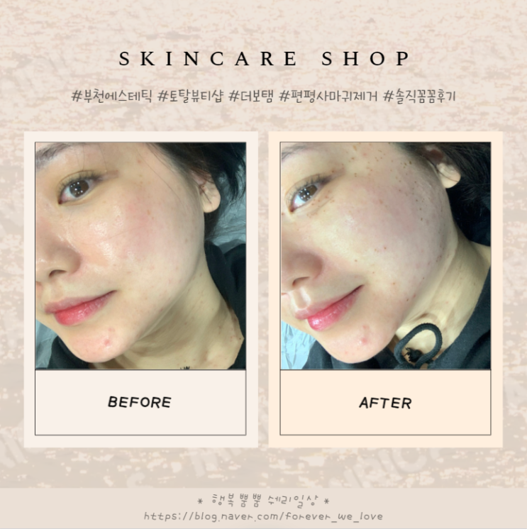  부천 편평사마귀제거 #더보탬 상동역 토탈뷰티샵 얼굴전체 편평사마귀관리 솔직후기, 주차