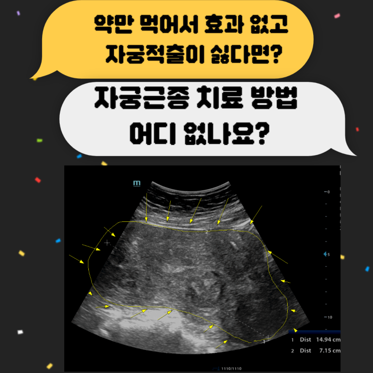  자궁15Cm 자궁하이푸진짜후기 자궁적출 다발성근종