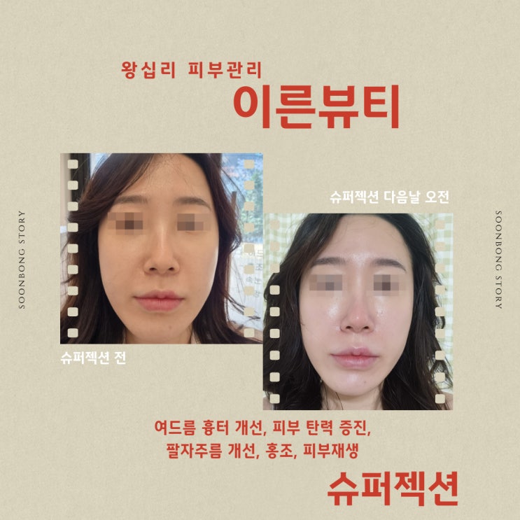  왕십리피부관리 눈으로 즉각보여지는 피부탄력 및 흉터재생 슈퍼젝션 이른뷰티 대만족 후기