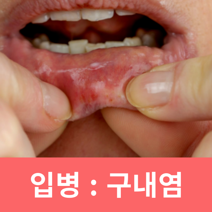  입병 낫는법 종류 원인 연고 구내염 알보칠
