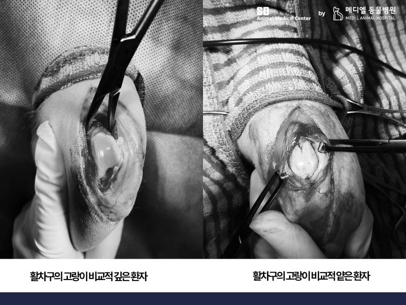 활차구 깊이 비교 이미지