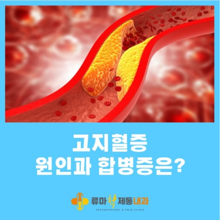  대구 칠곡 고지혈증 전문 류마척제통내과