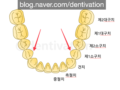  교정할 때 발치는 왜 하는거에요? 발치교정, 소구치발치, 작은어금니발치 교정