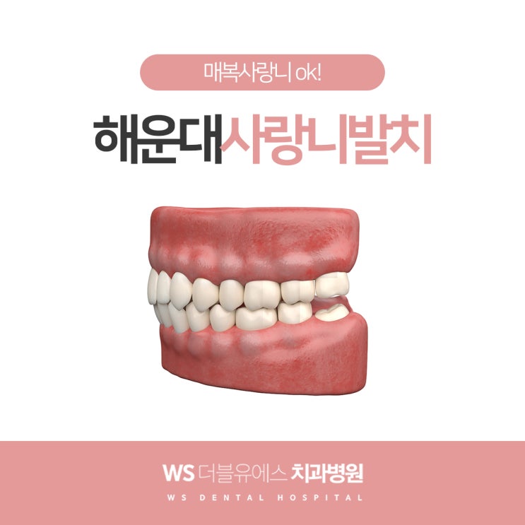  해운대사랑니발치 매복도 상관없이