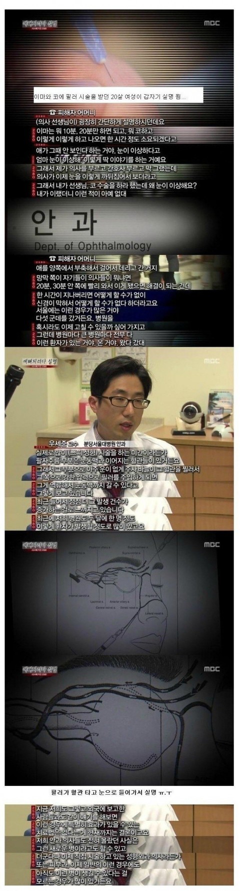  코 필러 수술 후 실명 사례 급증
