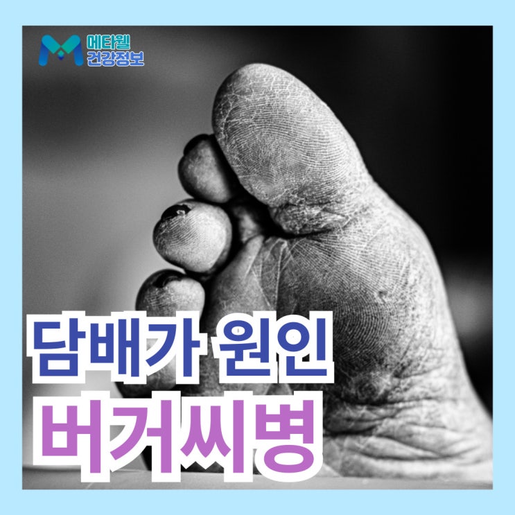  버거씨병 초기 증상, 흡연이 원인?! 폐색성 혈전혈관염 검사 치료 예방법까지 총정리