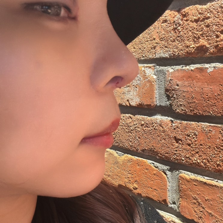  가넷성형외과 내돈내산 대공사 후기! (수술전~수술8일차)코수술4번째