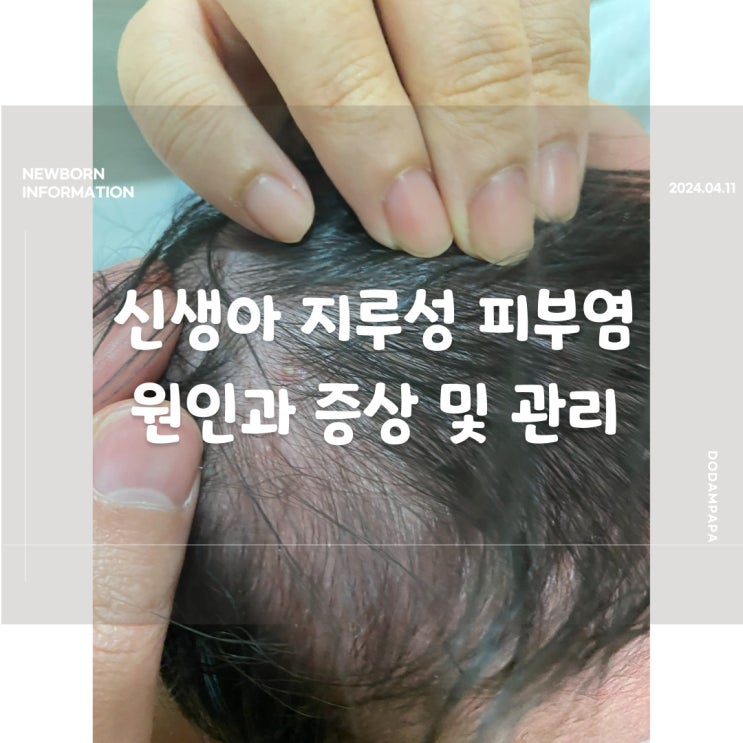 신생아 지루성 피부염 원인과 증상 및 관리 신생아 지루성 피부염 원인과 증상 및 관리