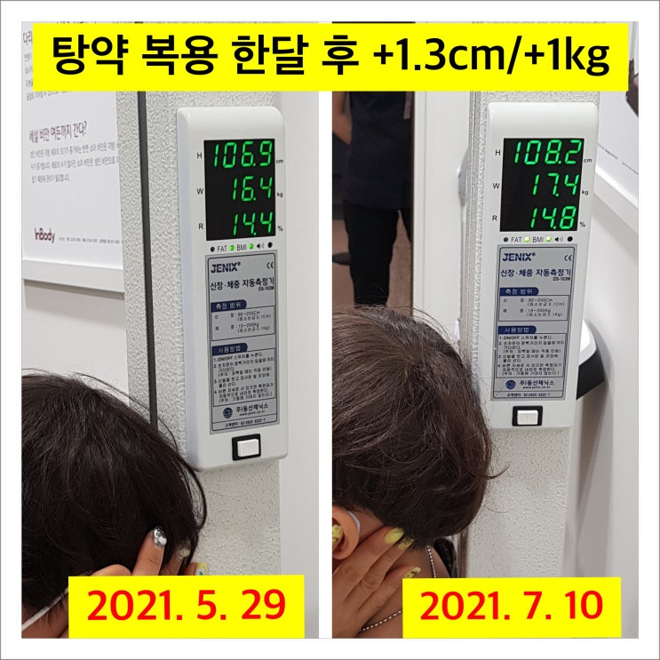  성장한약 복용 한달 1.3 cm 자라난 후기