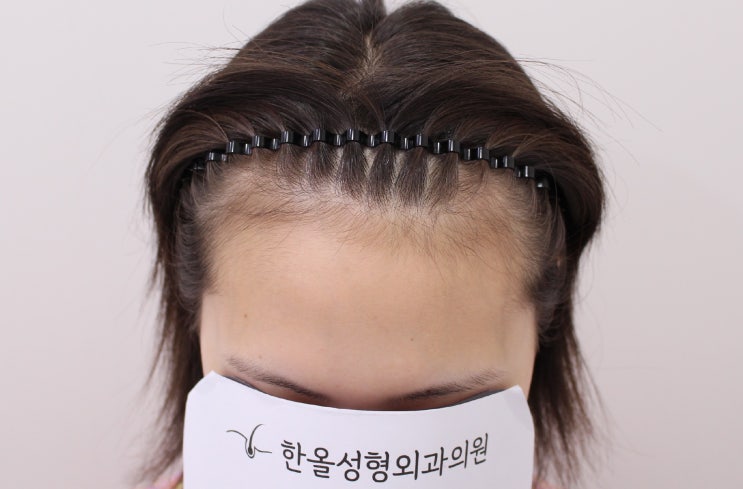 20대 여성 헤어라인 교정 절개 3000모 2주 경과