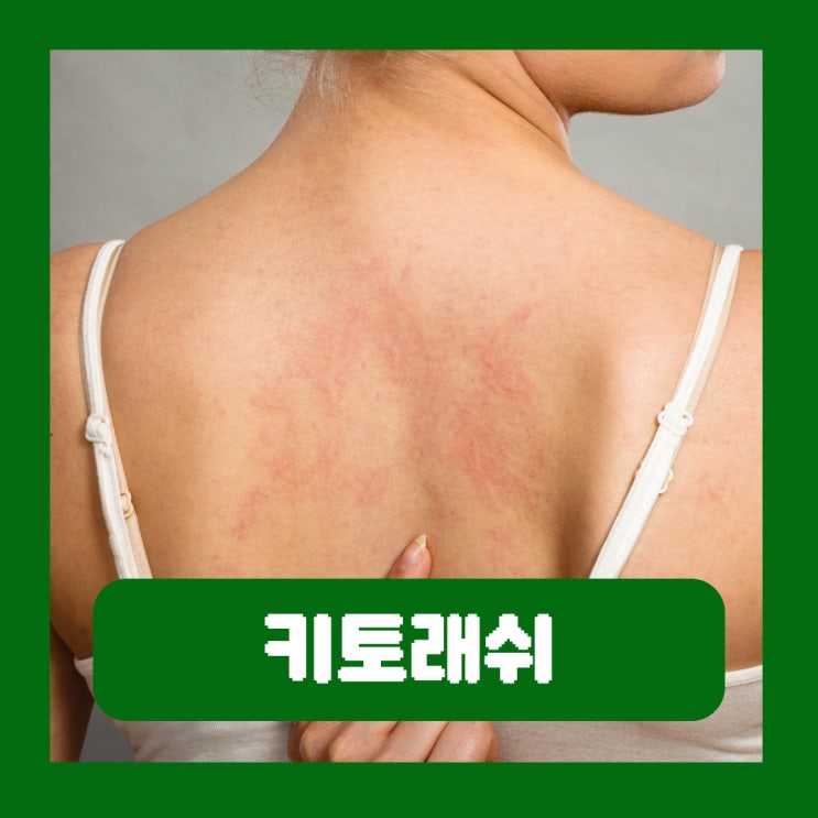  키토래쉬 극복 두드러기 원인 증상 치료
