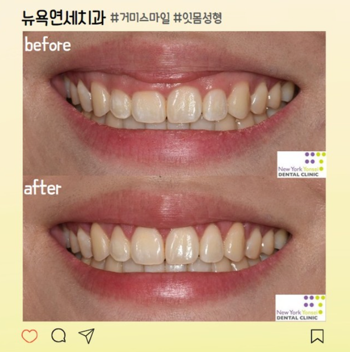  강남역 치과 추천 뉴욕연세치과 잇몸성형 비용 후기