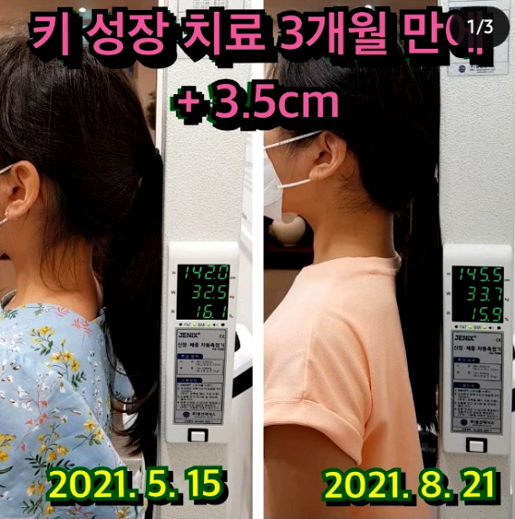  코로나 시기, 3개월만에 3.5cm 성장한 사례