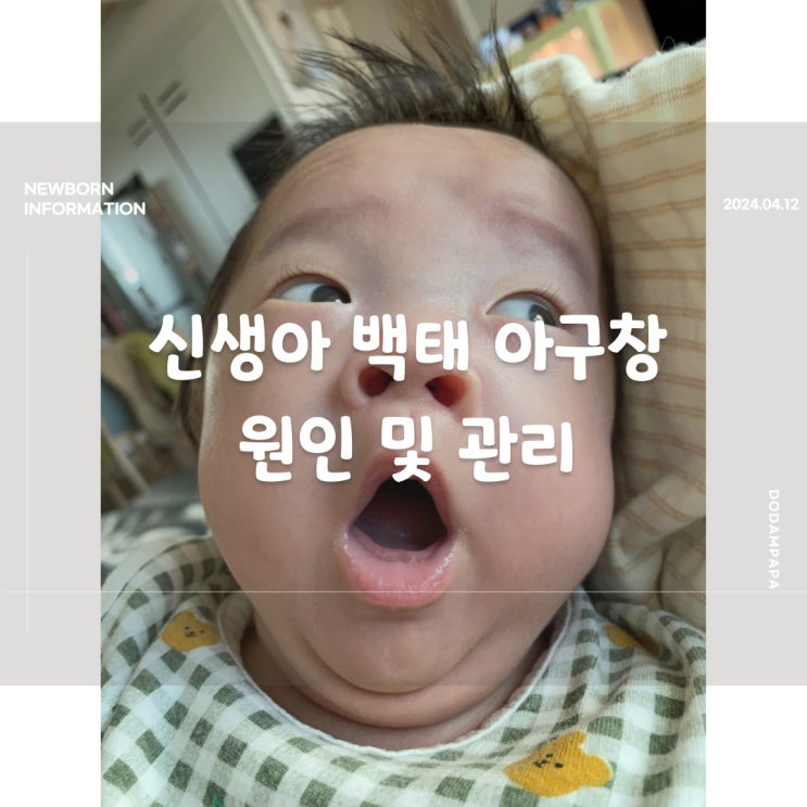 신생아 백태 아구창 원인 및 관리 신생아 백태 아구창 원인 및 관리