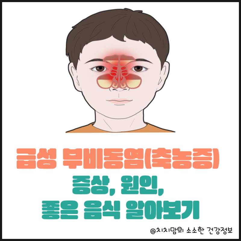코막힘의 끝판왕 급성 부비동염(축농증) 증상, 원인 및 부비동염에 좋은 음식 알아보기!