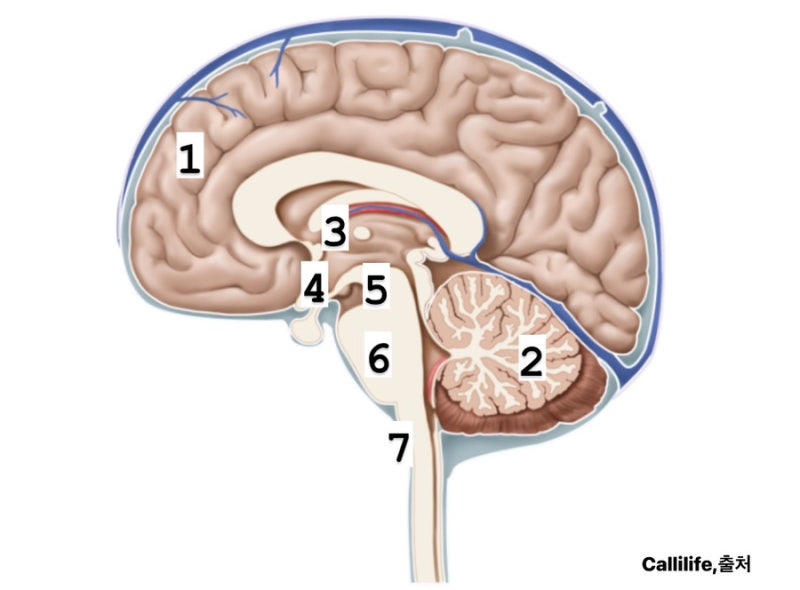 뇌내출혈(Intracerebral Hemorrhage, ICH) : 네이버 블로그