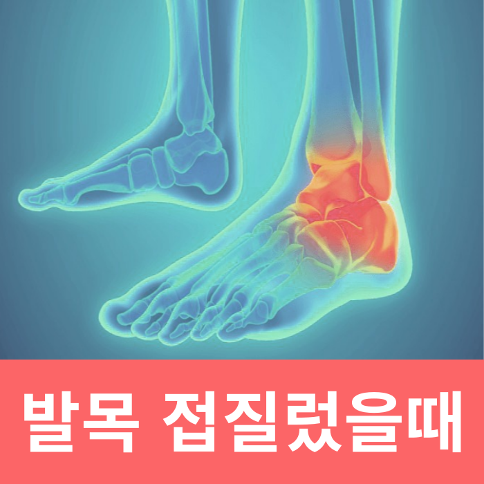 발목 접질렀을때 파스 붓기 냉찜질 증상 치료방법