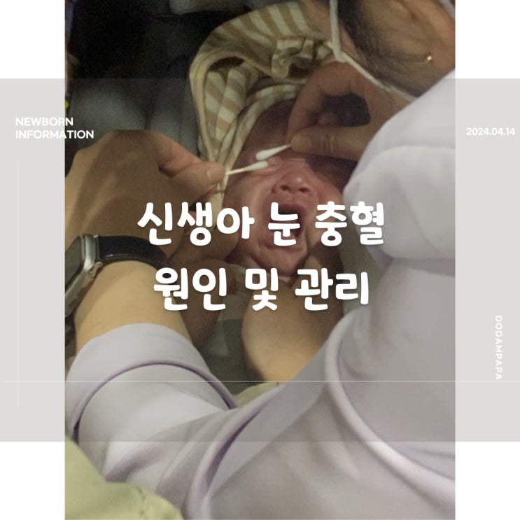 신생아 눈 충혈 원인 및 관리 신생아 눈 충혈 원인 및 관리