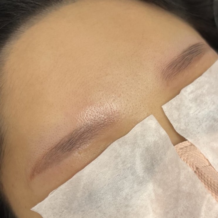  안산눈썹문신제거 꾸준히 해도 제거가 느리다면