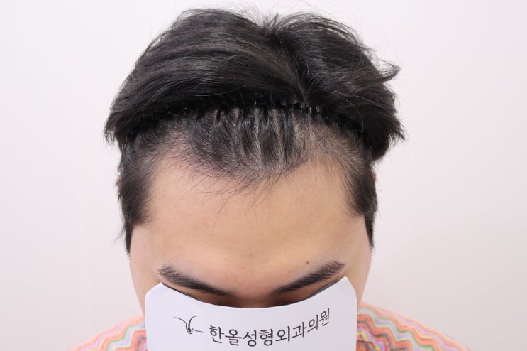  20대 남성 헤어라인 비절개 3000모 2주 경과