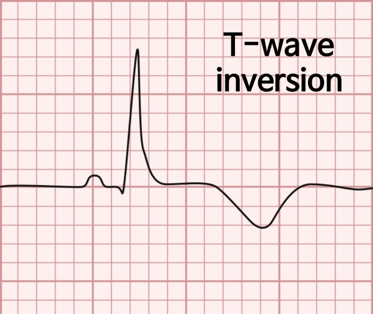  T-wave inversion (T-파 역전) EKG에 대한 임상적의의에 대해서 알아봐요
