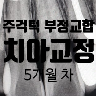  비수술 주걱턱 부정교합 치아교정 악궁확장장치 5개월 차 솔직후기 비용 부작용