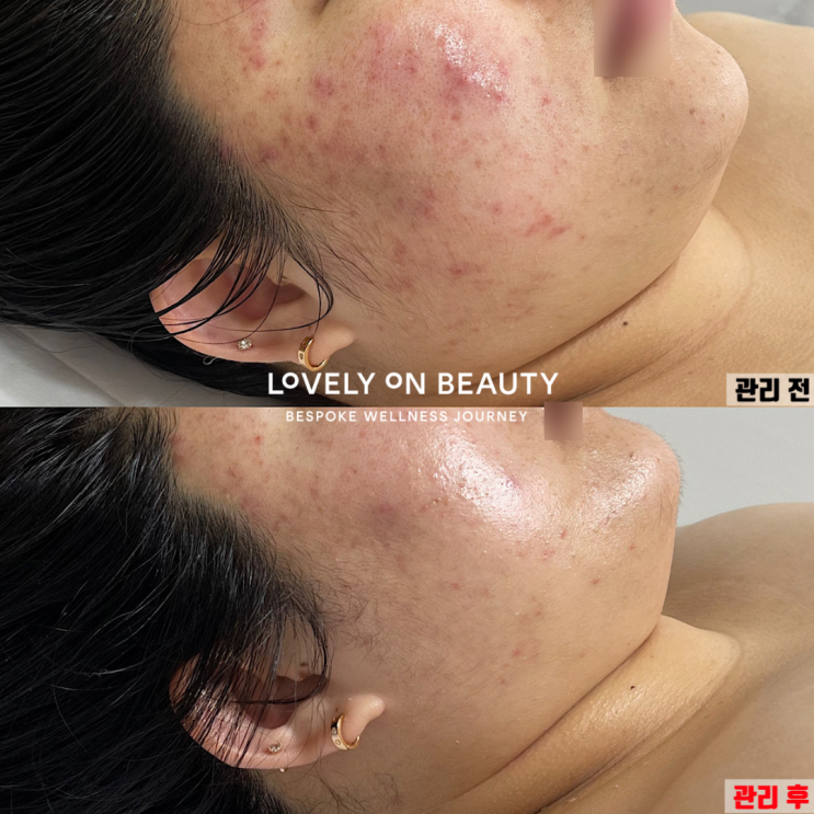  진주 여드름 흉터 생기는 이유 2가지