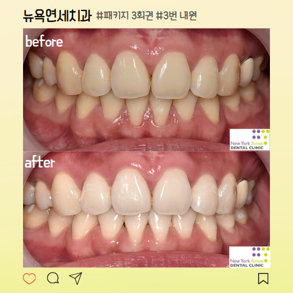 강남역치아미백 누런이빨 개선이 필요하다면