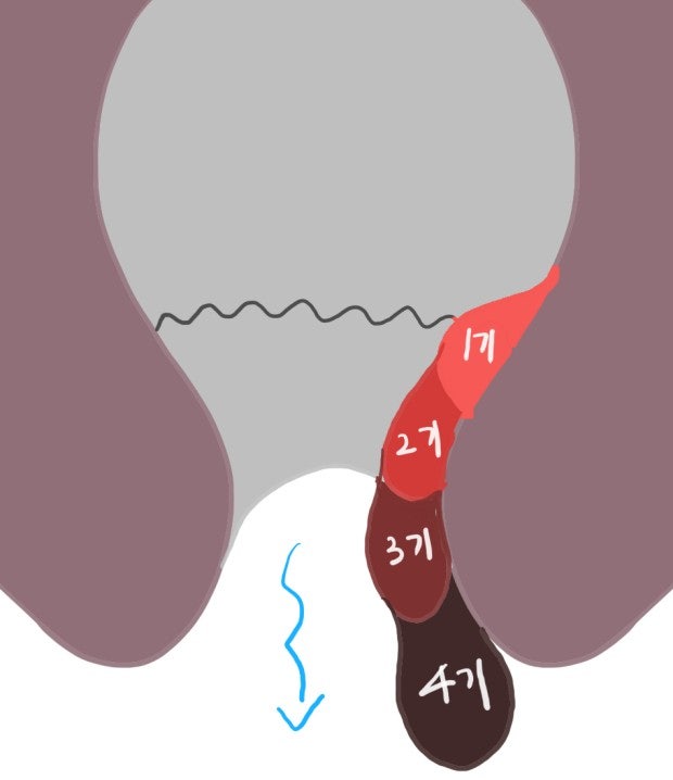 [3월 16일 기록] 포항 경주 영덕 항문외과 치질 수술 항문 병원 항외과 다녀온 후기