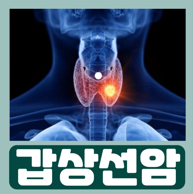 갑상선암 임파선 전이는 어떻게 알 수 있을까? 증상과 진단 방법 알아보기