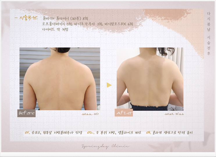  강서구 승모근 보톡스 효과 및 다이어트시술 후기
