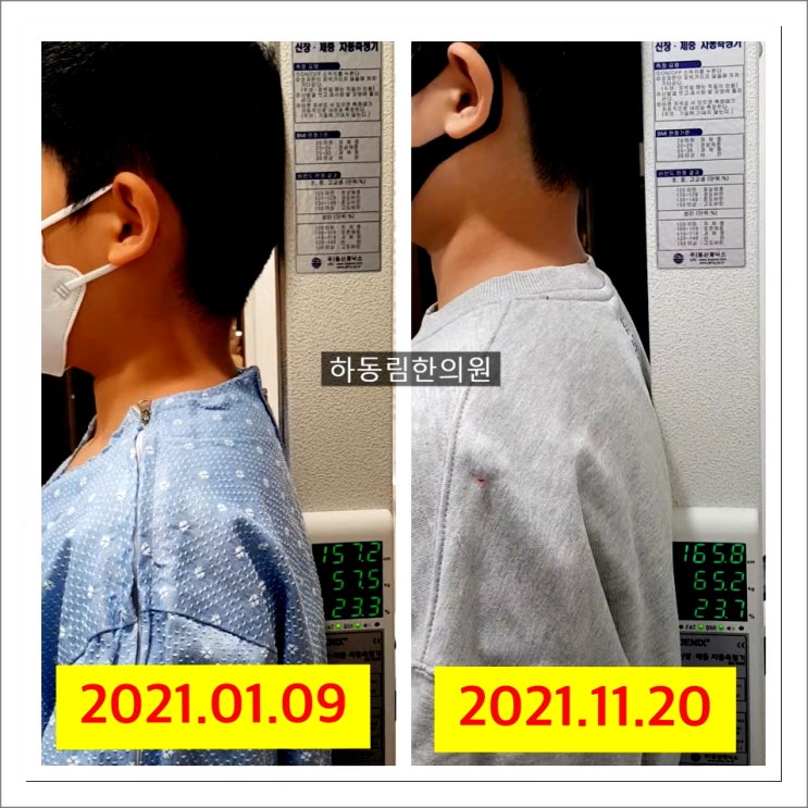  성장 한약 치료 10개월동안 8.6cm 자라난 후기