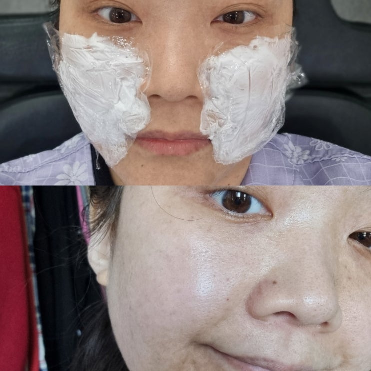 물광 윤광피부 만들기 신논현역피부과 스킨부스터 리제반PN 2cc 2주차 후기