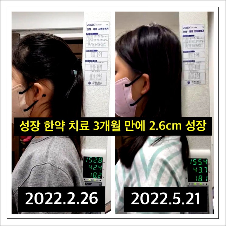  키 성장 치료 3개월 만에 2.6cm 성장한 사례